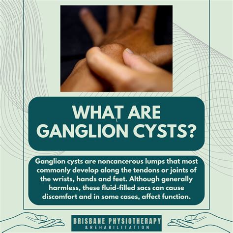What is are Ganglion Cysts? - Brisbane Physiotherapy & Podiatry