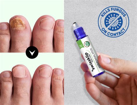The best toenail fungus treatment for 2026, according to dermatologists Aesthetic