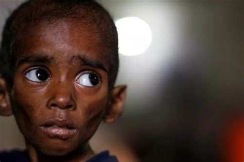 Bill Gates Thinks We Can Fix Malnutrition In 20 Years, If We Understand ...