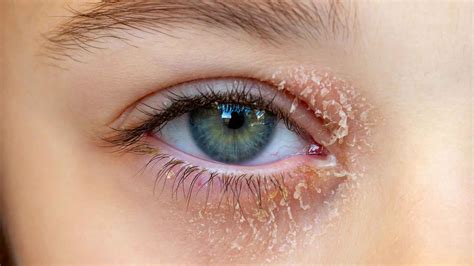 Understanding and Treating Dry Eyelids: Expert Insights