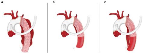 JCM | Special Issue : Open Questions in Aortic Disease: New Problems ...