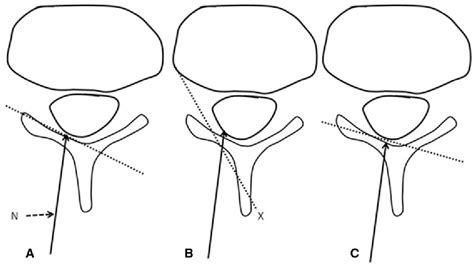 Image result for Contralateral Oblique View