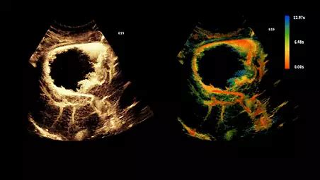 EPIQ Elite | Philips