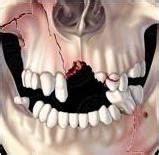 Repair of Facial Fractures| Toothy,s Dental