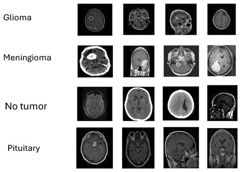 Evaluating Machine Learning Techniques for Brain Tumor Detection with ...