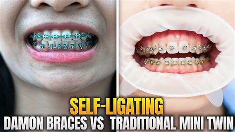 Self-Ligating Brackets Vs Braces at Craig Alston blog