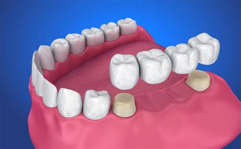 Common Dental Bridge Complications