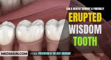 Wisdom Tooth Cyst Removal 的图像结果