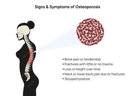 Premium Vector | SIgns and symptoms of osteoporosis in vector