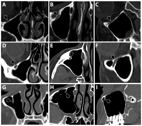 The Associations between the Maxillary Sinus Volume, Infraorbital Ethmoid Cells, and the ...