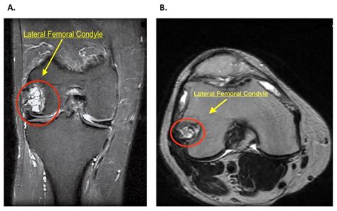 Intercondylar Notch Cyst