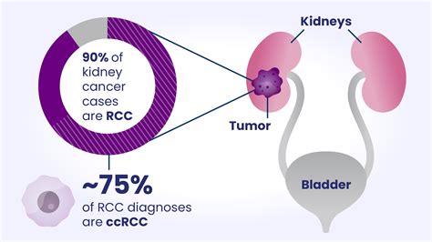 How Common Is Kidney Cancer