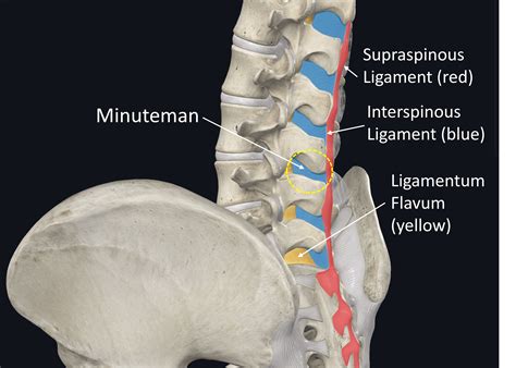 MIS, the Minuteman, and Fusion: Is This a Good Idea? - Regenexx