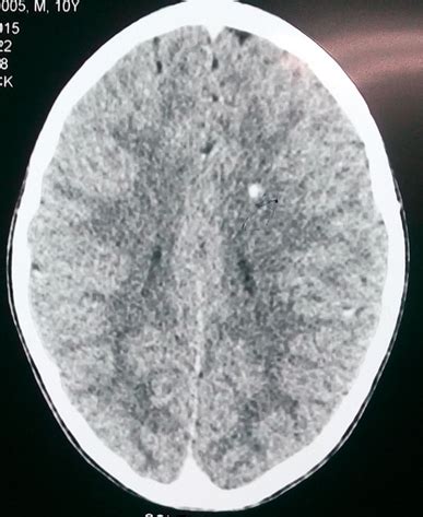 Cysticercosis cutis- an unusual guide to neurocysticercosis | Pediatric ...
