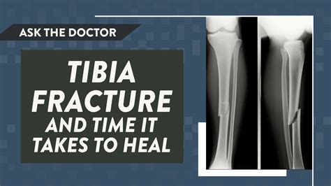 Ask the Doctor: Tibia fracture and time it takes to heal | Dr Geier