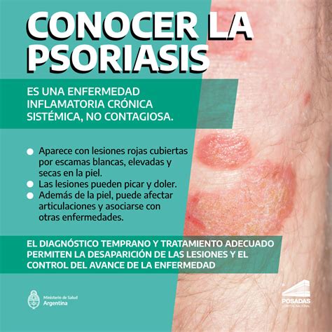 Soriasis. Tipos, Causas, Síntomas Y Signos, Diagnóstico Y Tratamiento ...