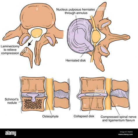Ligamentum Flavum And Facet Hypertrophy