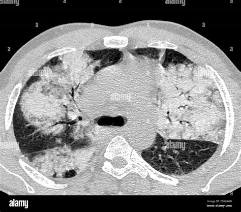 Pneumonia. Computed tomography (CT) scan of an axial section through the chest of a 60-year-old ...
