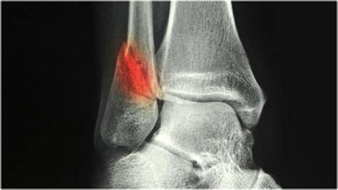 I have an ankle fracture - Will I need surgery? - Orthofoot MD