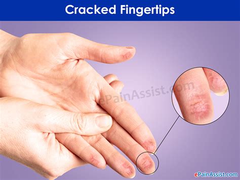 Cracked Fingertips: Causes, Treatment, Prevention