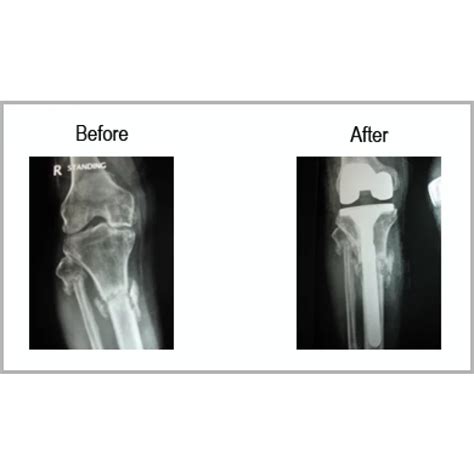 Old Fracture Of Spin Bone With Osteoarthritis - Dr Samir Nanavati