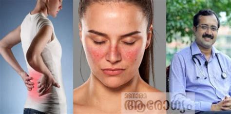 കവിളിൽ പൂമ്പാറ്റ ചുവപ്പായി തുടക്കം; തീവ്രമായാൽ വൃക്കകളെ തകർക്കും ...