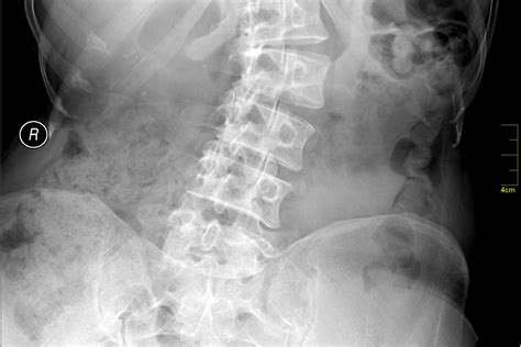 Xray Versus Eos For Scoliosis Schroth Scoliosis An Intelligent