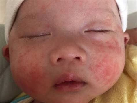 一到冬季，宝宝就满脸红疹？皮肤医生：做好3件事，远离皴裂湿疹|湿疹|皴裂|宝宝_新浪新闻