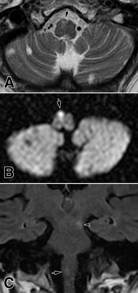 Anatomic and MRI bases for medullary infarctions with patients’ presentation - Journal of Stroke ...