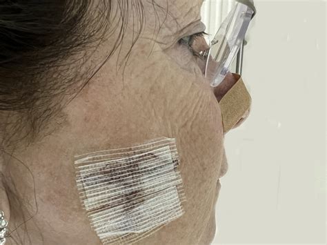 Everything You Need to Know About Mohs Surgery - A Guide