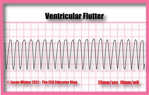 The ECG Educator & Mentor Blog : Ventricular Flutter