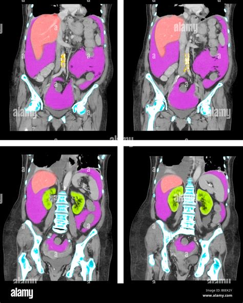 Ct Abdomen And Pelvis