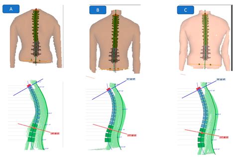 Does Improvement towards a Normal Cervical Sagittal Configuration Aid ...