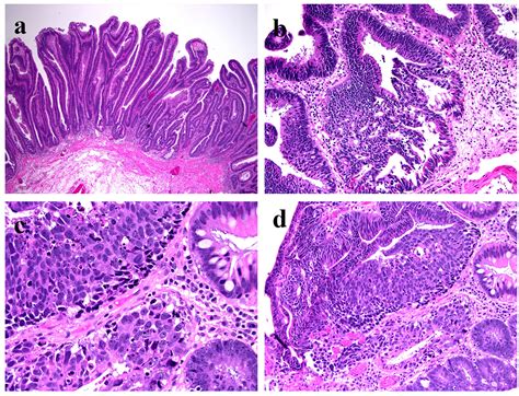 Tubulovillous Adenoma With Dysplasia