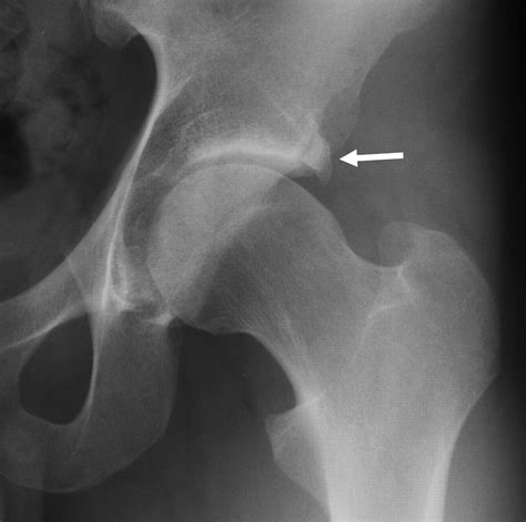 Impingement Femoroacetabulär – Universitätsklinikum Heidelberg ...