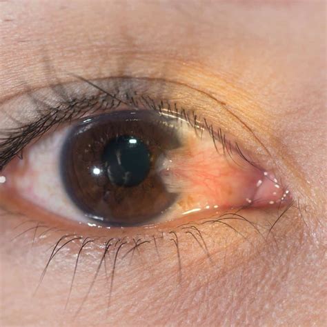 Image result for Common Eye Problems