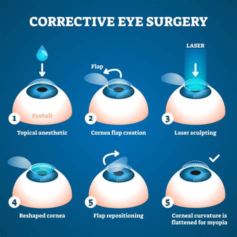 Chirurgie laser des yeux, technique du LASIK à Uccle