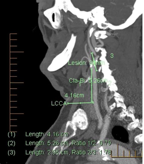 Figure 1 from Anatomic eligibility for transcarotid artery revascularization and transfemoral ...