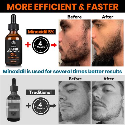 Does Minoxidil Thicken Beard Hair at Lola Goll blog