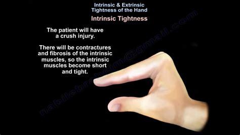 Hand Contracture Exercises Pdf at Dennis Aguayo blog