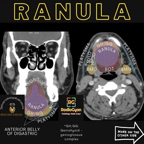 Ranula | Radiology Case