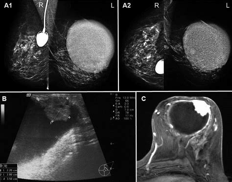 Intracystic Papillary Carcinoma of the Breast: A Diagnostic Challenge with Major Clinical Impact ...