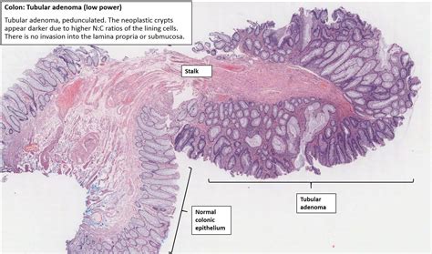 What Is Colonic Mucosa With Adenomatous Change - Infoupdate.org