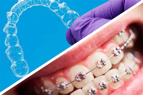 Invisalign vs. Traditional Braces: Pros & Cons for Teens & Adults in ...