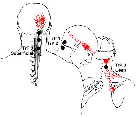 INTRODUCTION TO HEAD PAIN | Occipital neuralgia, Migraine headaches, Migraine