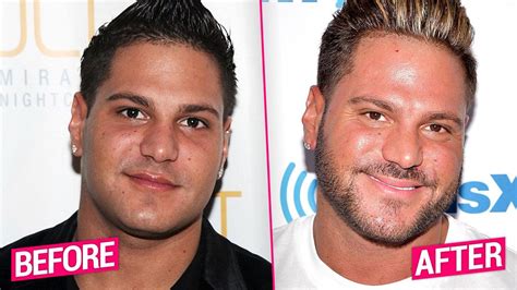 Pauly D's Plastic Surgery: Before & After? What Doctors Say