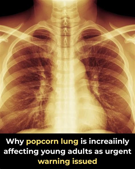 Doctors Warn Of Rising Cases Of “Popcorn Lung” Among Young Adults — Here’s What You Need To Know
