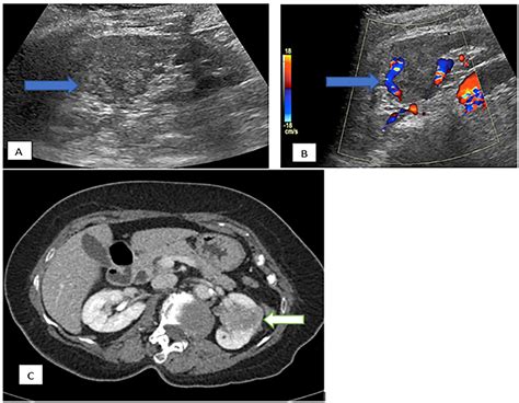 Renal Mass Mimicking Prominent Columns of Bertin: A Case Series ...