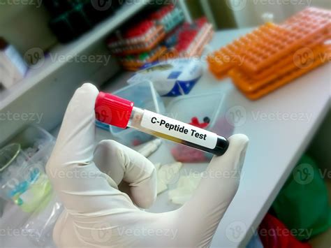 Blood sample tube for C peptide test, diagnosis of diabetes disease 5464629 Stock Photo at Vecteezy