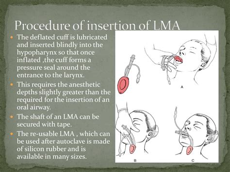 Image result for LMA Machine